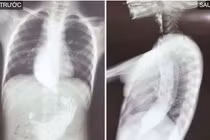 Trẻ sợ ăn kéo dài không ngờ do co thắt tâm vị nguyên phát