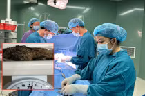 Lấy thành công búi tóc 0,5 kg trong dạ dày bé gái ở Quảng Ngãi