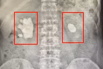 Để sỏi tồn tại 20 năm, viêm san hô chiếm gần hết thận