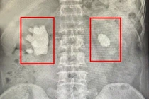 Để sỏi tồn tại 20 năm, viêm san hô chiếm gần hết thận