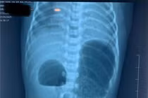 Phẫu thuật cho trẻ sơ sinh mắc bệnh hiếm tắc tá tràng do tụy nhẫn