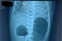 Phẫu thuật cho trẻ sơ sinh mắc bệnh hiếm tắc tá tràng do tụy nhẫn