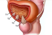 Địa chỉ vàng: Các bệnh viện điều trị tốt ung thư bàng quang