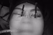 Hy hữu y khoa, 2 chiếc đũa đâm sâu vào 2 mắt trên cùng 1 người bệnh