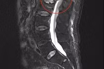 Tổn thương tủy sống do loãng xương gây xẹp đốt sống dễ liệt chi
