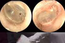 Bác sĩ gắp thành công bọ chó sống trong tai bệnh nhân 60 tuổi