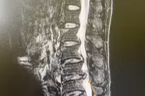 Liệt vĩnh viễn, mất chức năng đại tiểu tiện do thoát vị đĩa đệm, hẹp ống sống