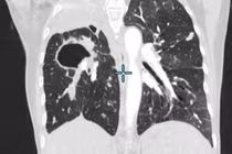 Can thiệp tắc mạch phế quản cứu bệnh nhân ho ra máu mức độ nặng, suy hô hấp