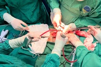 Bỏ khối u bàng quang khổng lồ giải cứu quả thận đang "chết đuối"