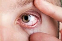 1/3 bệnh nhân đái tháo đường bị mắc bệnh võng mạc