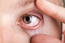 1/3 bệnh nhân đái tháo đường bị mắc bệnh võng mạc