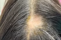 Rụng tóc từng mảng tăng nguy cơ mắc bệnh lý tâm thần