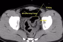 Nam thanh niên thủng đại tràng do bị vòi rửa xe xịt vào hậu môn