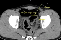 Nam thanh niên thủng đại tràng do bị vòi rửa xe xịt vào hậu môn