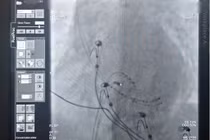 Đốt sóng cao tần cứu bệnh nhân nữ rối loạn nhịp tim nguy kịch