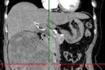 Loại bỏ khối u thận 1,2kg cho người bệnh 72 tuổi đau âm ỉ vùng lưng hông