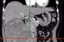 Loại bỏ khối u thận 1,2kg cho người bệnh 72 tuổi đau âm ỉ vùng lưng hông