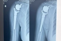 Khớp vai nhân tạo phục hồi khớp gãy nát sau tai nạn cho cụ bà 73 tuổi