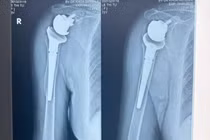 Khớp vai nhân tạo phục hồi khớp gãy nát sau tai nạn cho cụ bà 73 tuổi