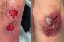 Nhiều người ngộ độc methotrexate nặng khi uống thuốc trị bệnh da liễu