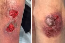 Nhiều người ngộ độc methotrexate nặng khi uống thuốc trị bệnh da liễu