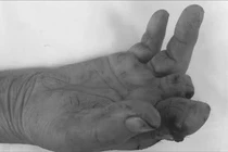 Máy cắt rau cắt cụt 2 ngón tay khi đang chế biến thực phẩm tại nhà