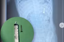 Vỗ lưng đẩy đinh vít 2,5 cm ra ngoài khiến dị vật trôi sâu hơn