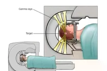 Ung thư di căn não điều trị thế nào hiệu quả?