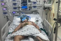 Trẻ 9 tuổi đa chấn thương, sốc mất máu, lóc da diện rộng được cứu sống