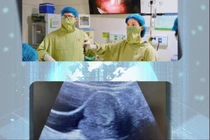 Vật lạ sa ra ngoài âm hộ, thiếu nữ 19 tuổi không ngờ polyp âm đạo lớn