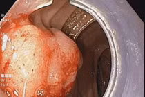 Đau vùng hạ sườn không ngờ phải cắt khối tá tụy do ung thư