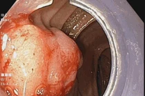 Đau vùng hạ sườn không ngờ phải cắt khối tá tụy do ung thư