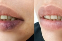 Teo môi suốt 3 năm, đi khám mắc lupus ban đỏ dạng đĩa