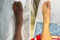 Đang ngủ chân đau dữ dội, hoại tử suýt phải cắt cụt do tắc mạch chi 