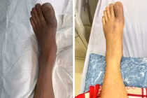 Đang ngủ chân đau dữ dội, hoại tử suýt phải cắt cụt do tắc mạch chi 