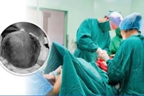 Cứu hai mẹ con sản phụ thai hơn 30 tuần rau bong non thể nặng