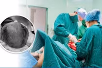 Cứu hai mẹ con sản phụ thai hơn 30 tuần rau bong non thể nặng