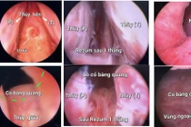 Kỹ thuật chữa bệnh lý tuyến tiền liệt 'xịn' nhất hiện nay