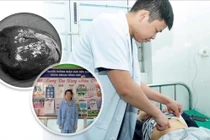 Cắt lách bán phần điều trị u nang lách khổng lồ cho bệnh nhi 14 tuổi