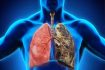 Dấu hiệu cảnh báo ung thư phổi 