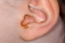 Cảnh báo nguy cơ tổn thương tai ở trẻ nhỏ từ việc tự ngoáy tai