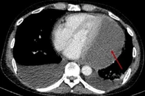 Đau ngực người đàn ông bị tràn mủ màng ngoài tim hiếm gặp
