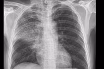 Cứu sống bệnh nhân viêm phổi nặng có bệnh nền xơ gan