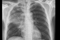 Cứu sống bệnh nhân viêm phổi nặng có bệnh nền xơ gan