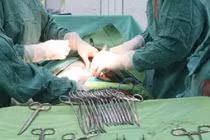 Khối u nang buồng trứng khủng chèn ép nội tạng cụ bà 98 tuổi