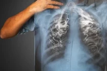 Vì sao không hút thuốc lá vẫn ung thư phổi?