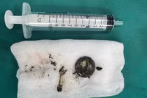 Bệnh nhi bị bỏng thực quản do nuốt phải pin cúc áo