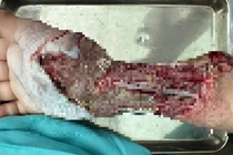 Hồi phục cánh tay dập nát cho trẻ 10 tuổi do tường đổ