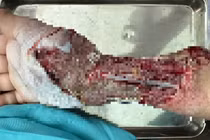 Hồi phục cánh tay dập nát cho trẻ 10 tuổi do tường đổ