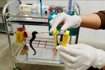 Chảy máu mũi kéo dài không ngờ đỉa 10 cm trú ngụ